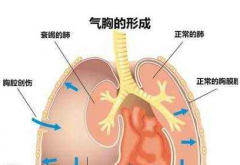 創傷性氣胸分為哪三類？