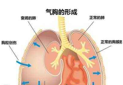 創(chuàng)傷性氣胸的示意圖