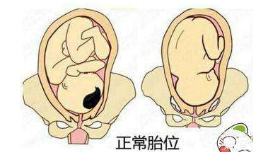 較正的胎位