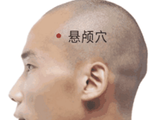 懸顱穴刺灸法