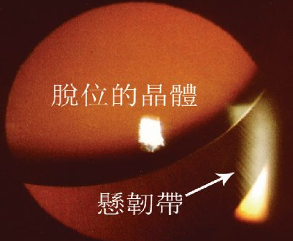 晶體脫位