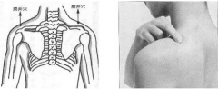 中醫(yī)針刺肩井穴治療中風(fēng)