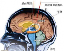 腦外傷伴發(fā)的精神障礙的癥狀表現(xiàn)及其治療方法！