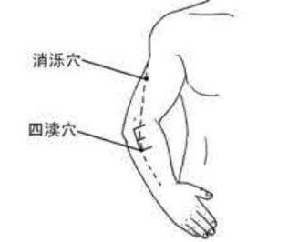 消濼穴穴位配伍