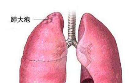 肺大泡的發(fā)病原因