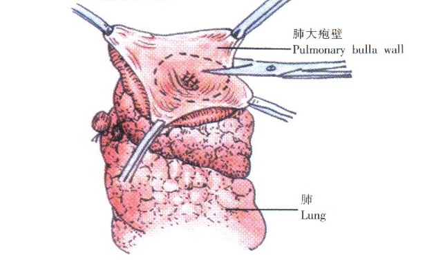 肺大泡的疾病鑒別