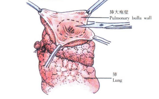 肺大皰的治療方法