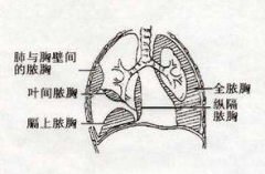 膽固醇膿胸的疾病鑒別及其護理方法！