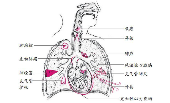 肺寄生蟲病的檢查
