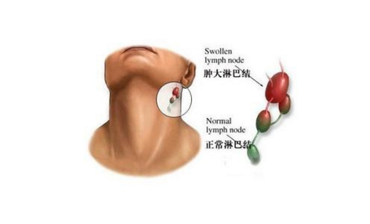 肺假性淋巴瘤的發病原因