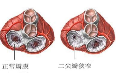 二尖瓣狹窄