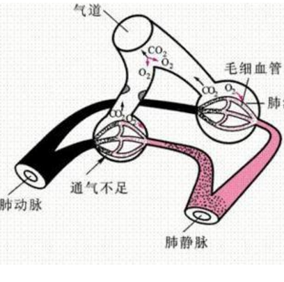 肺泡通氣低下綜合征如何診斷？它的癥狀表現(xiàn)及其治療方法有哪些？