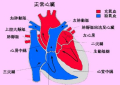 風(fēng)濕性二尖瓣狹窄可以治好嗎？風(fēng)濕性二尖瓣狹窄的癥狀表現(xiàn)