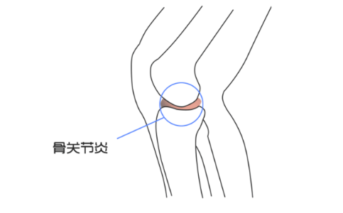 關節炎食療