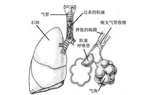 肺炎鏈球菌肺炎的發病原因